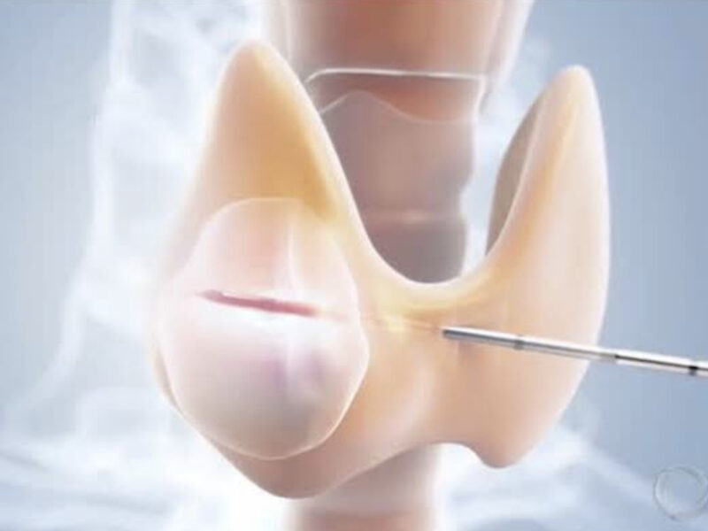 Dr. Robledo Alievi Cirurgião; cirurgião de cabeça e pescoço RS; ablação percutânea de nódulo de tireoide; cirurgia para câncer de tireoide; tratamento câncer de pele no rosto; cirurgia de nódulo na tireoide; Clínica Vitaro Ijuí RS; reconstrução facial pós câncer de pele; especialista em câncer de laringe; cirurgia de glândulas salivares; tratamento minimamente invasivo tireoide; segunda opinião para cirurgia de cabeça e pescoço; oncologia cirúrgica Ijuí; malformação congênita no pescoço tratamento; telemedicina cirurgião de cabeça e pescoço;lesões na laringe;rouquidão persistente;reconstrução facial;carcinoma basocelular;manchas e sinais no rosto;ablação percutânea;nódulo na tireoide;caroço no pescoço