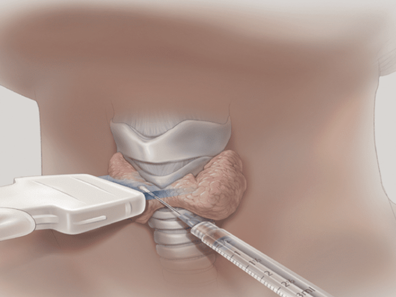 Dr. Robledo Alievi Cirurgião; cirurgião de cabeça e pescoço RS; ablação percutânea de nódulo de tireoide; cirurgia para câncer de tireoide; tratamento câncer de pele no rosto; cirurgia de nódulo na tireoide; Clínica Vitaro Ijuí RS; reconstrução facial pós câncer de pele; especialista em câncer de laringe; cirurgia de glândulas salivares; tratamento minimamente invasivo tireoide; segunda opinião para cirurgia de cabeça e pescoço; oncologia cirúrgica Ijuí; malformação congênita no pescoço tratamento; telemedicina cirurgião de cabeça e pescoço;lesões na laringe;rouquidão persistente;reconstrução facial;carcinoma basocelular;manchas e sinais no rosto;ablação percutânea;nódulo na tireoide;caroço no pescoço