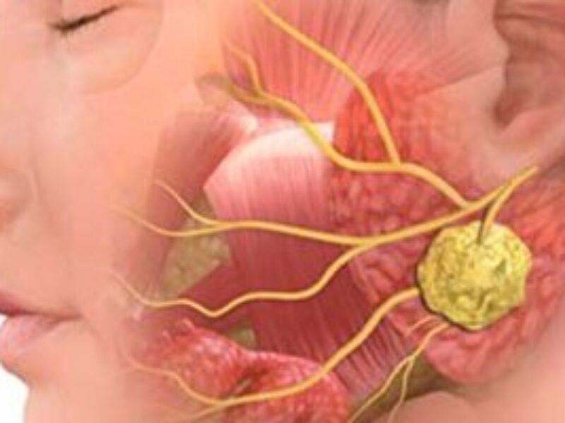 Dr. Robledo Alievi Cirurgião; cirurgião de cabeça e pescoço RS; ablação percutânea de nódulo de tireoide; cirurgia para câncer de tireoide; tratamento câncer de pele no rosto; cirurgia de nódulo na tireoide; Clínica Vitaro Ijuí RS; reconstrução facial pós câncer de pele; especialista em câncer de laringe; cirurgia de glândulas salivares; tratamento minimamente invasivo tireoide; segunda opinião para cirurgia de cabeça e pescoço; oncologia cirúrgica Ijuí; malformação congênita no pescoço tratamento; telemedicina cirurgião de cabeça e pescoço;lesões na laringe;rouquidão persistente;reconstrução facial;carcinoma basocelular;manchas e sinais no rosto;ablação percutânea;nódulo na tireoide;caroço no pescoço
