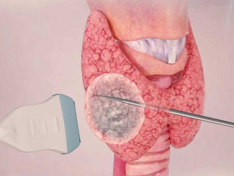 Dr. Robledo Alievi Cirurgião; cirurgião de cabeça e pescoço RS; ablação percutânea de nódulo de tireoide; cirurgia para câncer de tireoide; tratamento câncer de pele no rosto; cirurgia de nódulo na tireoide; Clínica Vitaro Ijuí RS; reconstrução facial pós câncer de pele; especialista em câncer de laringe; cirurgia de glândulas salivares; tratamento minimamente invasivo tireoide; segunda opinião para cirurgia de cabeça e pescoço; oncologia cirúrgica Ijuí; malformação congênita no pescoço tratamento; telemedicina cirurgião de cabeça e pescoço;lesões na laringe;rouquidão persistente;reconstrução facial;carcinoma basocelular;manchas e sinais no rosto;ablação percutânea;nódulo na tireoide;caroço no pescoço